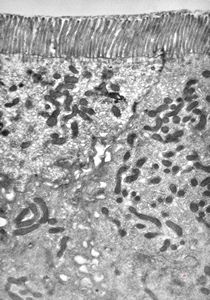F,5y. | immotile cilia syndrome - trachea F,5y. | immotile cilia syndrome - trachea